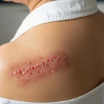 대상포진은 전염성이 있는지?